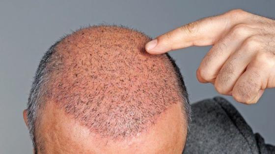 هل عمليات زراعة الشعر مجدية؟